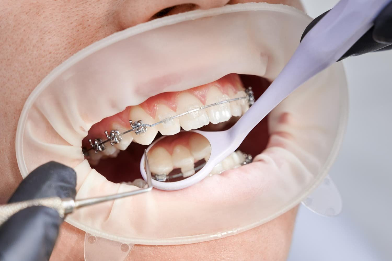 Orthodontics (Teeth Alignment)​