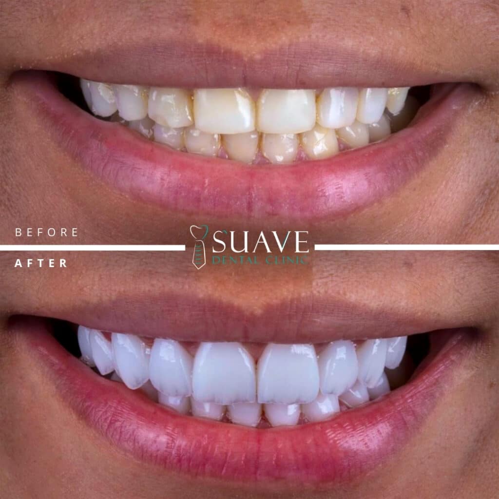 24 Emax Crowns set in Istanbul Suave Dental Clinic