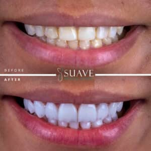 24 Emax Crowns set in Istanbul Suave Dental Clinic