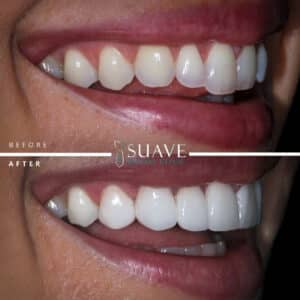 Zirconium Laminate Veneers in Zirconium Laminate veneers in the best cosmetic dentist in istanbul