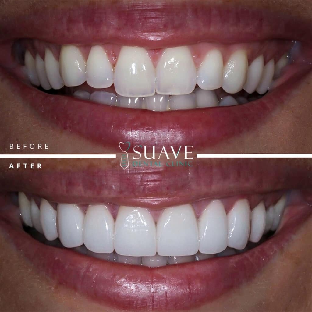 Zirconium Laminate veneers in the best cosmetic dental clinic in istanbul