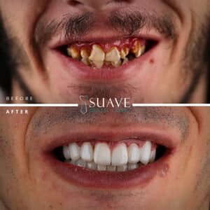 Amazing Turkey Teeth in Suave dental clinic in Istanbul