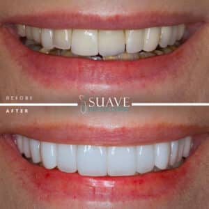 E-max Veneers in the best cosmetic dental clinic in Istanbul smile Gallery