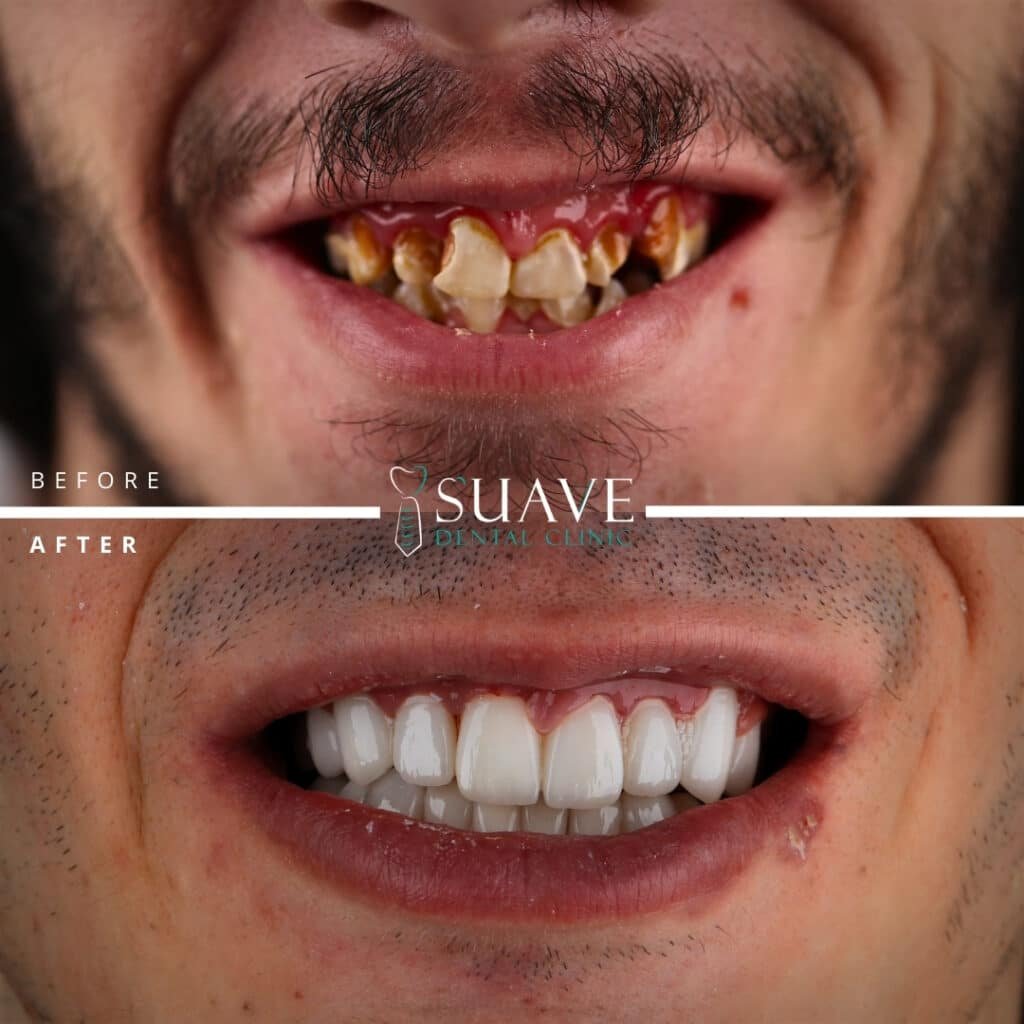 Tooth crown before and after- dental crown procedure in turkey