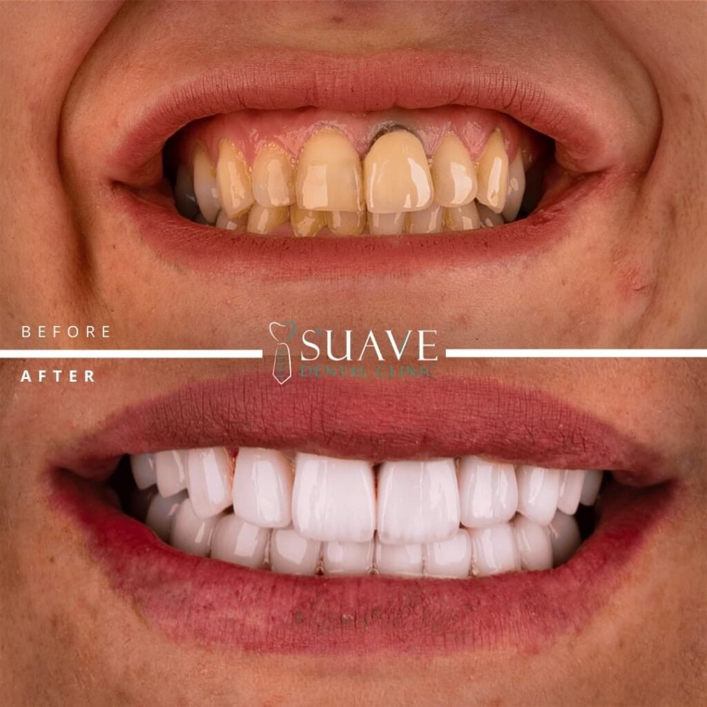 Cosmetic Dentistry before and after - dental clinic istanbul