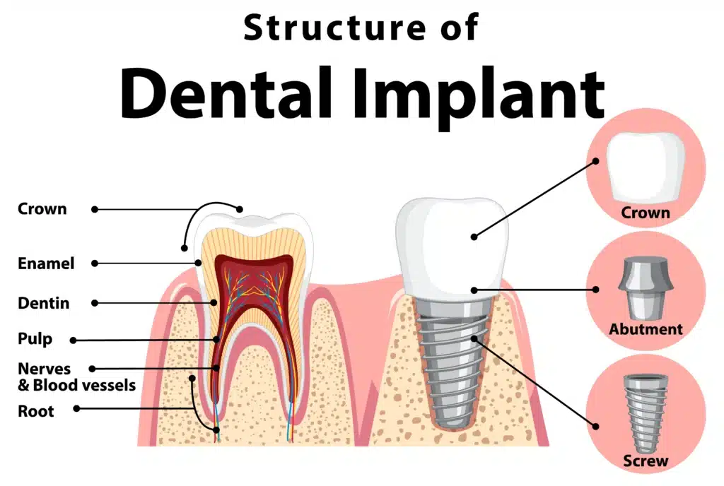 Structure of Dental Implant Dental crown Abutment Titanium Screw/ Implant Post