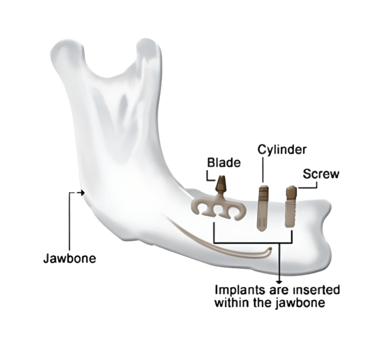 Endosteal Implants (within the bone):