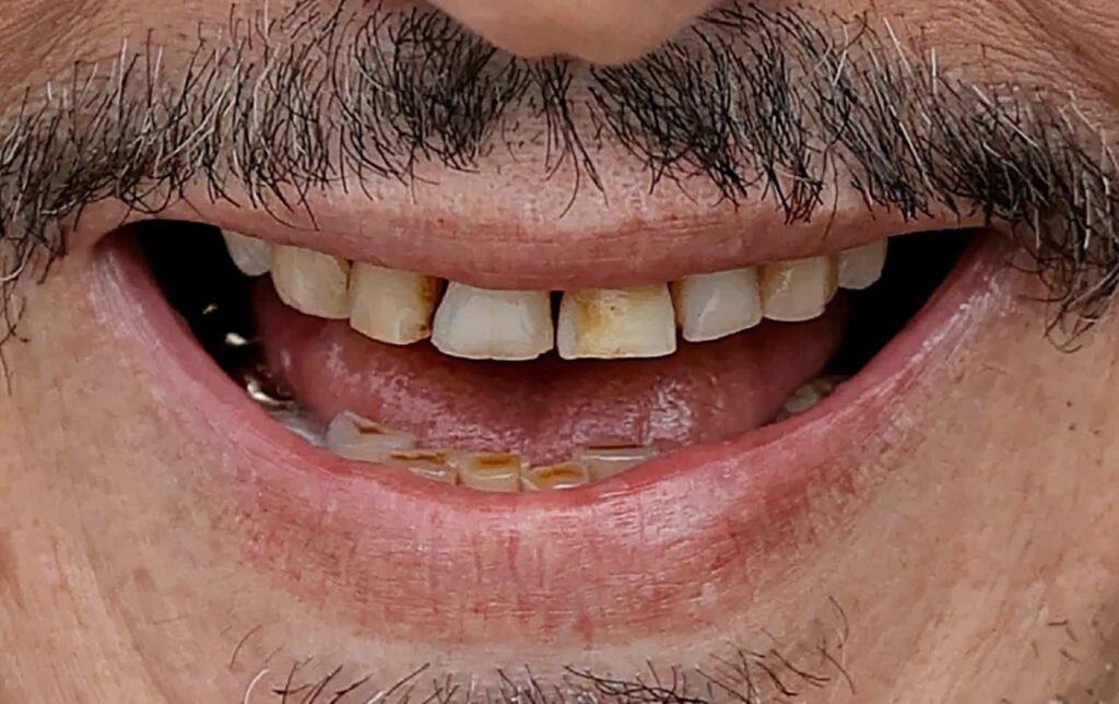 johnny depp rotten teeth