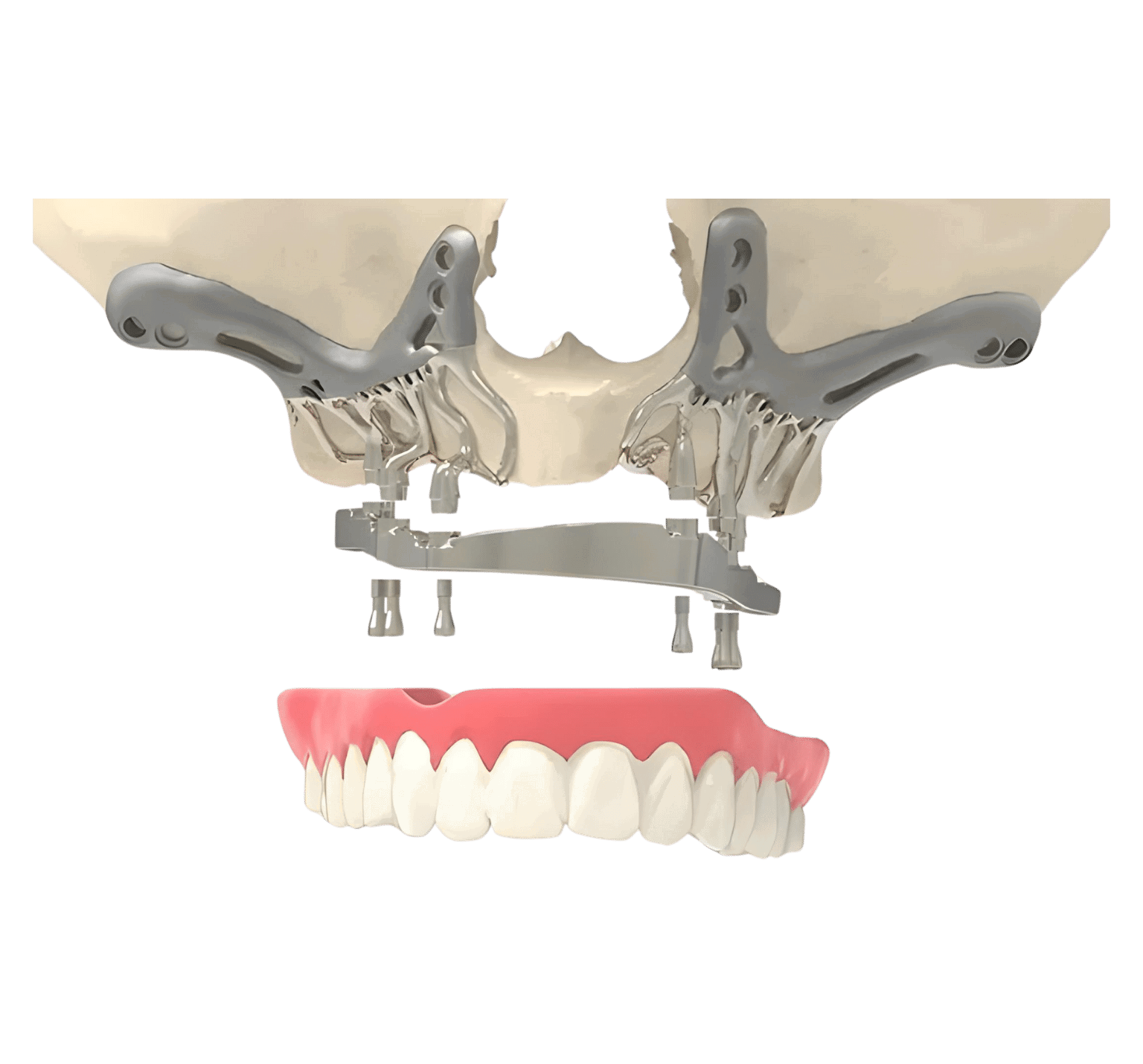 Subperiosteal Implants (on the bone)