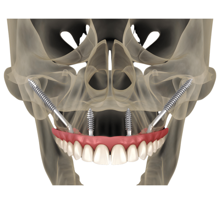 Zygomatic Implants (anchored in the cheekbone)