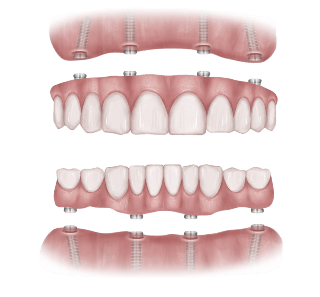 all on 4 dental implant and all on 6 dental implant