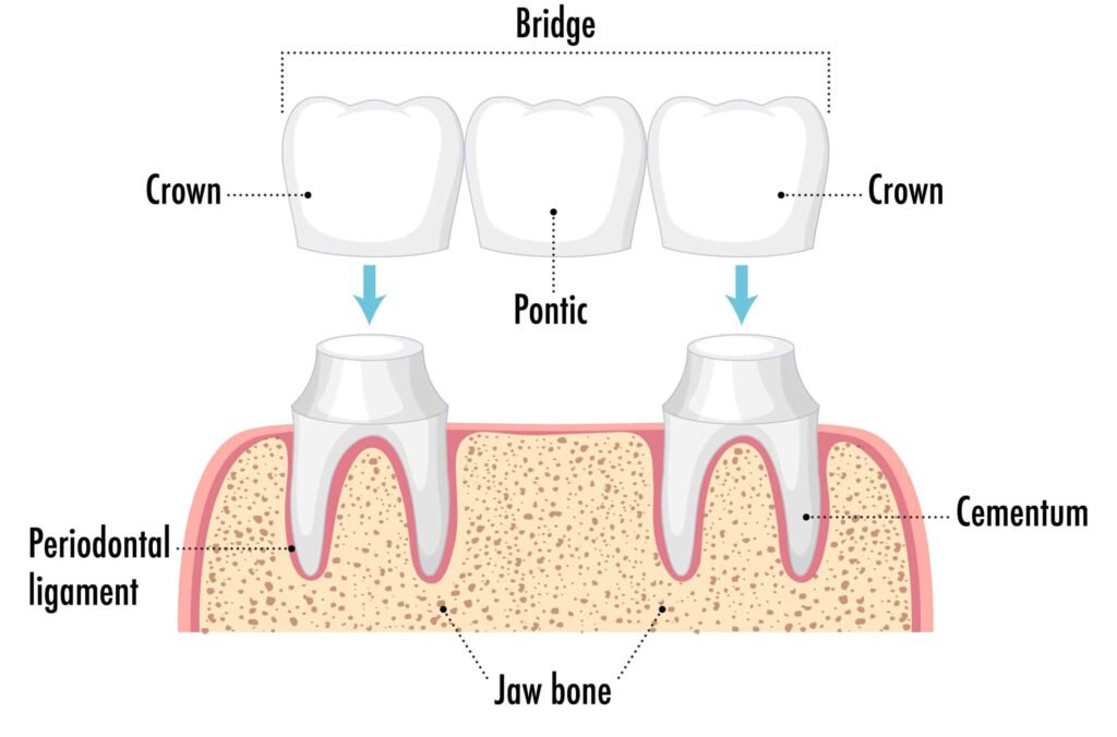 Conventional Dental Bridge