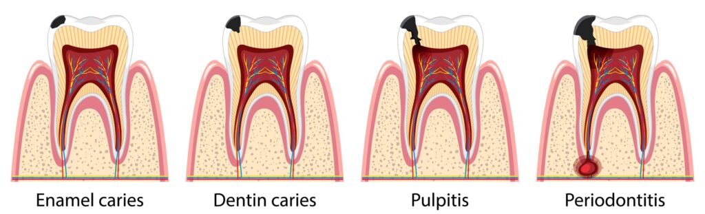 inflamed pulp (Pulpitis) treated by root canal treatment