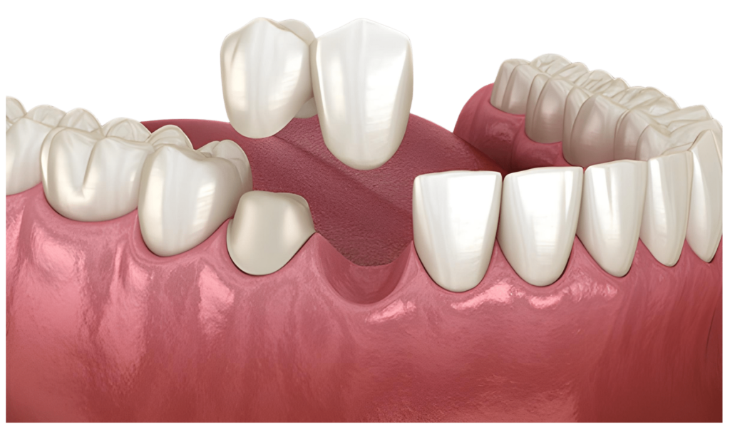 Cantilever Dental Bridges