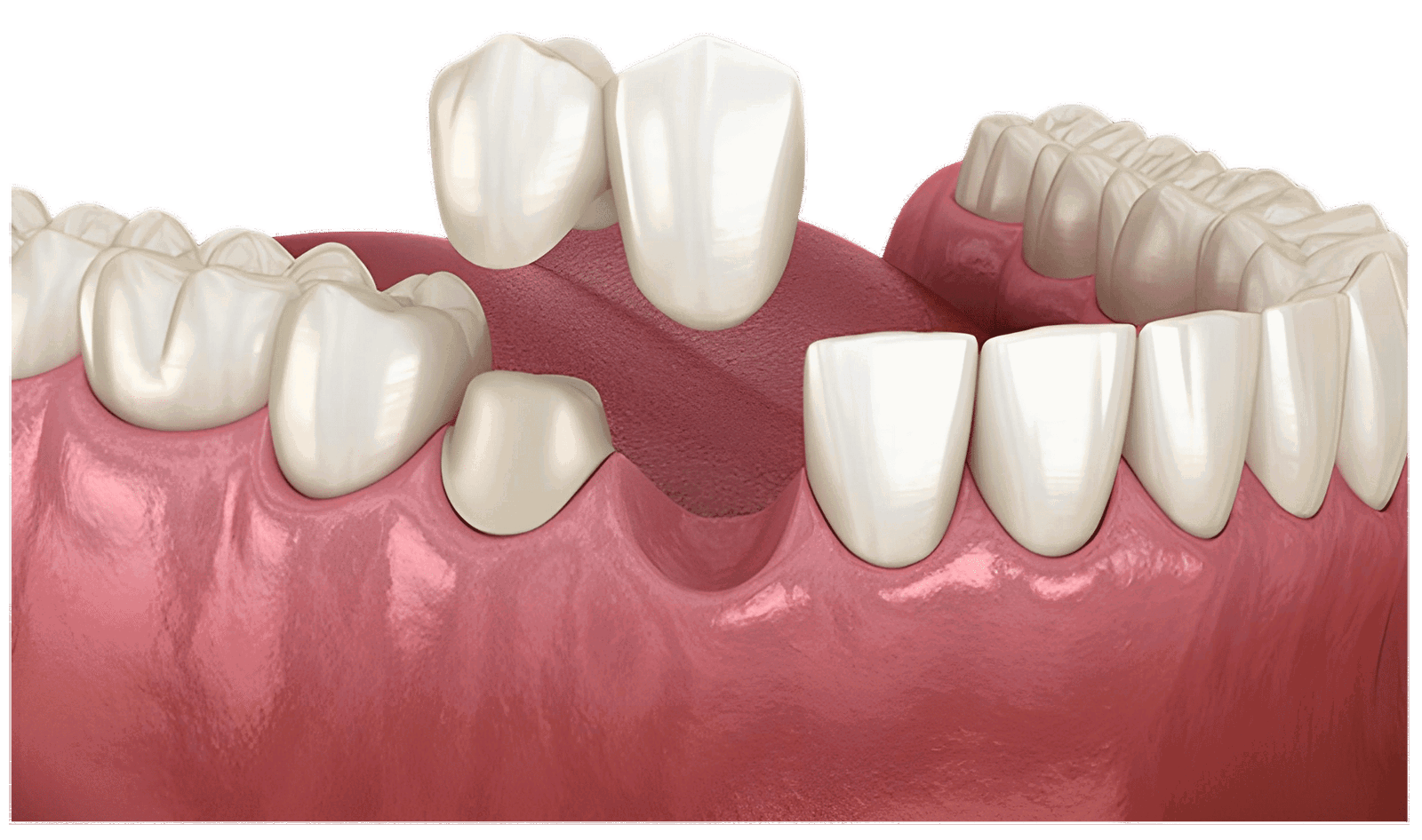 Cantilever Dental Bridges