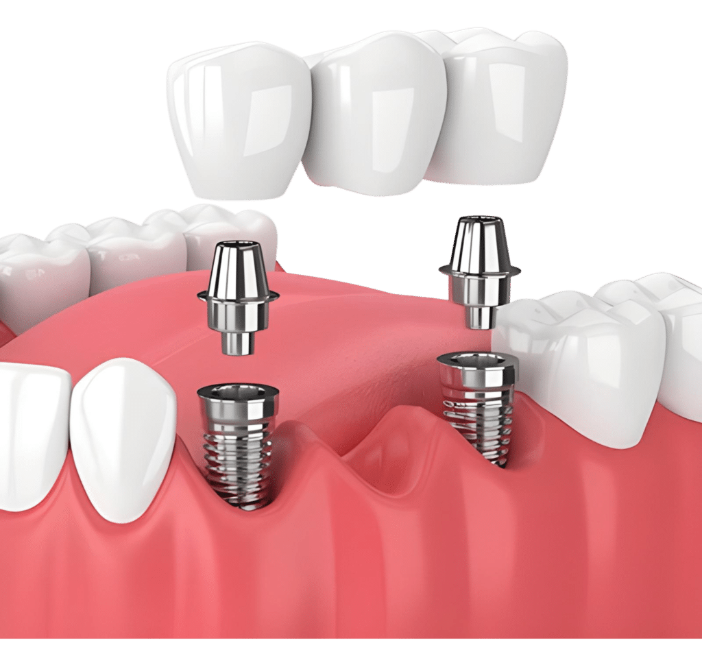 Implant Supported Dental Bridges