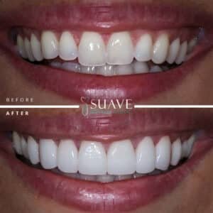 dental veneers