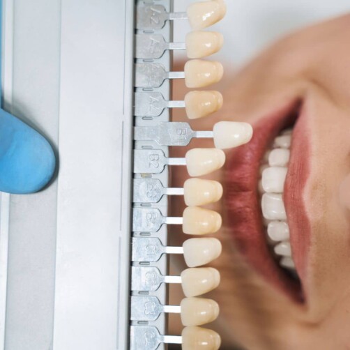 Dental Lumineers in Turkey