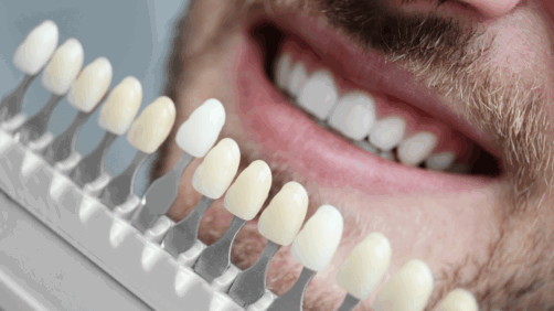 Emax Veneers: Your Ultimate Guide to a Perfect Smile