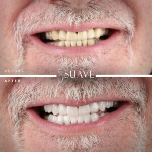 The Optimum Guide on How to Get a Hollywood Smile Makeover in Turkey