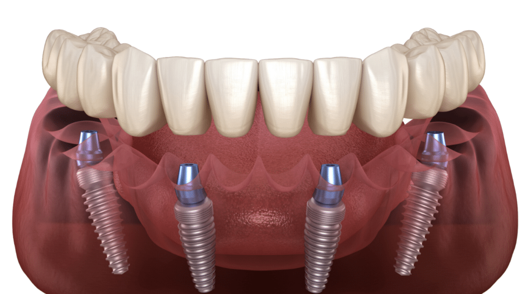 All-on-4 Dental Implants