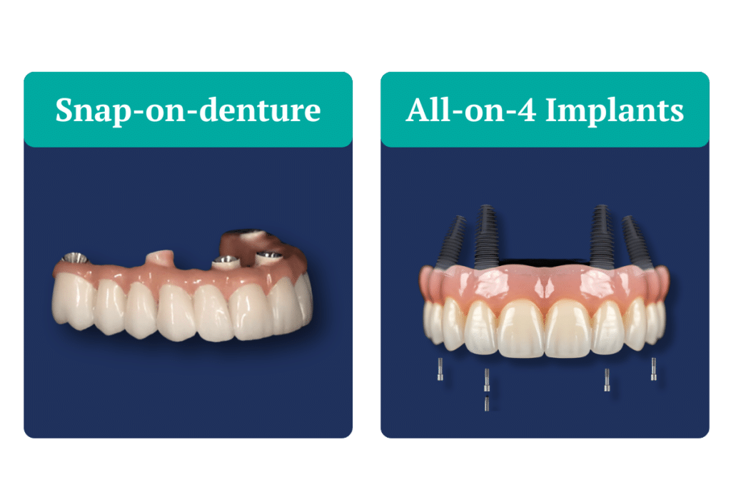 Comparison between Overdentures (Snap-On Dentures) and All-on-4/ All-on-6 Implants pros and cons 