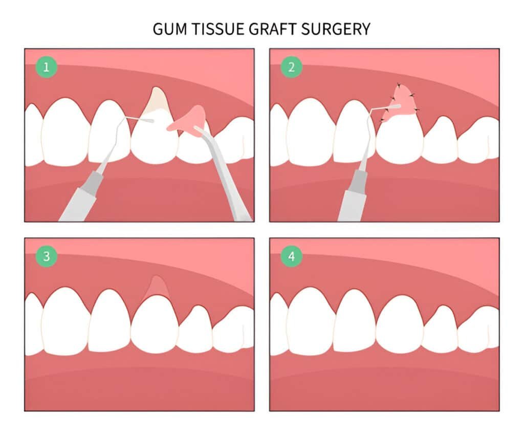 gum graft surgery procedure