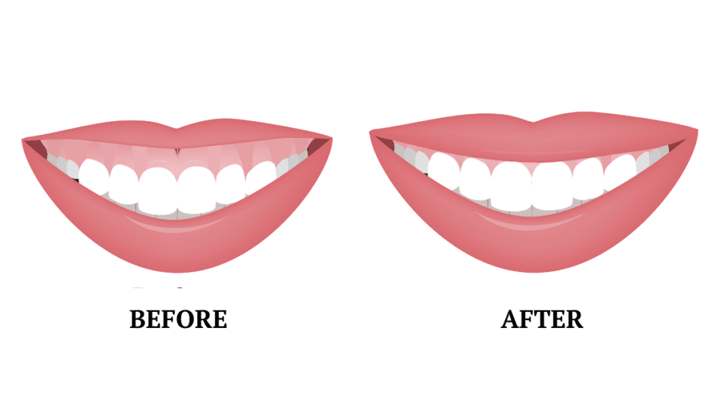 gummy smile before and after