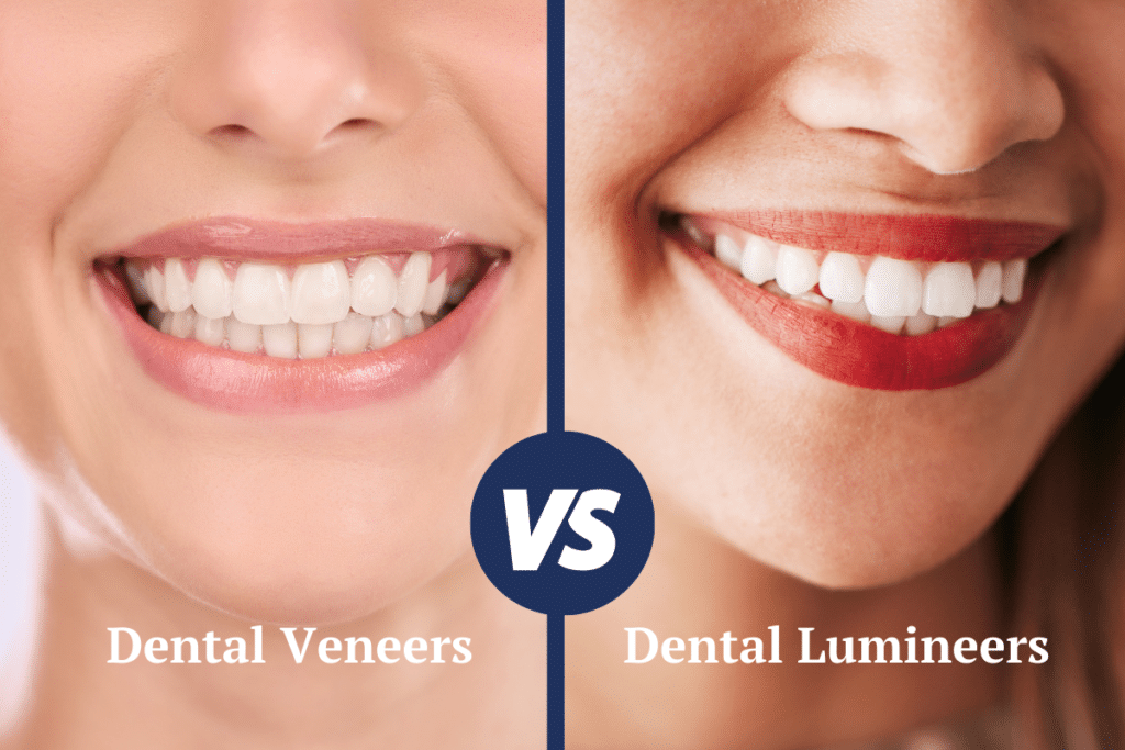 lumineers vs veneers