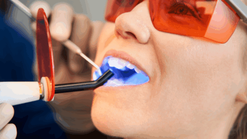 Dental Fillings: Types, Materials, Benefits, Comparison & Cost
