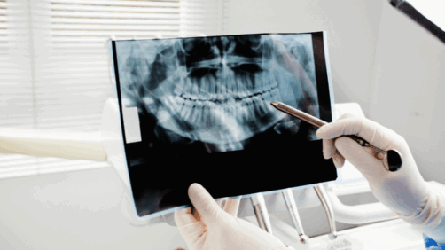 What Is Dental Bone Graft And Membrane