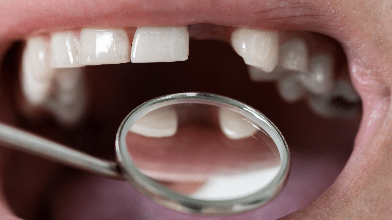 Cheap options for missing teeth