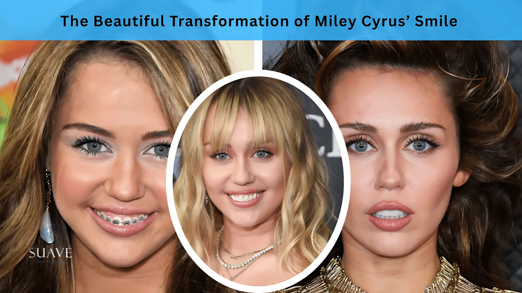 the transformation of Miley cyrus smile and dental teeth procedures