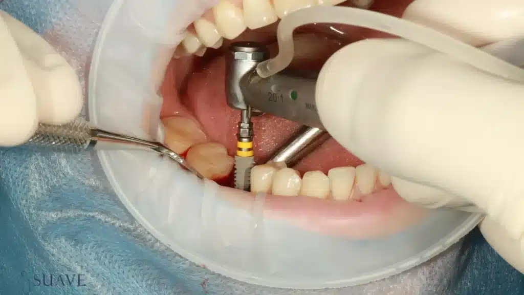 alternatives to dental implants from Suave Clinic