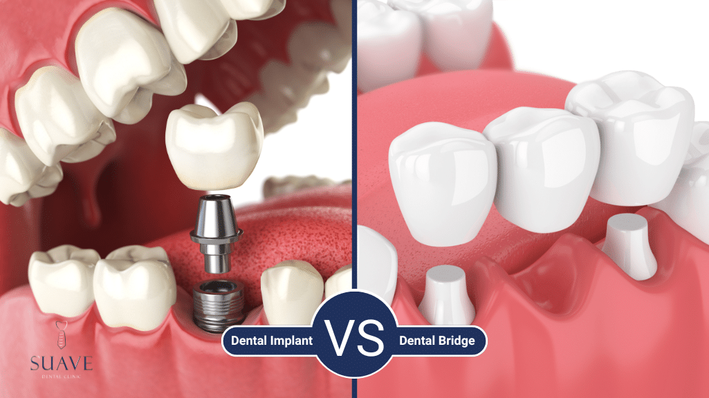 Dental Bridge Vs Implant - Suave Clinic