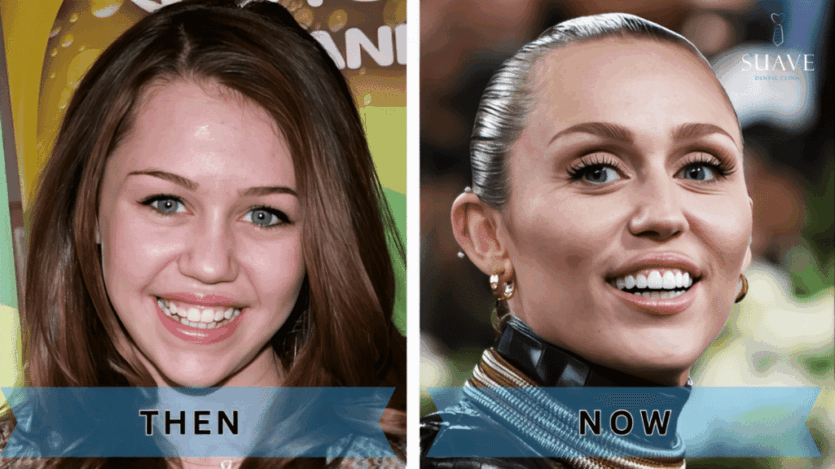 miley cyrus's teeth transformation now and then