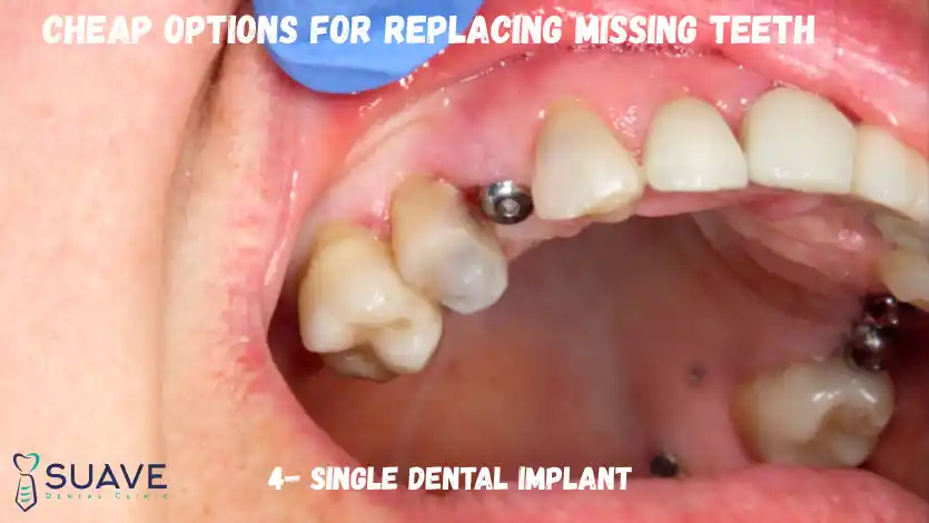 Cheap Options to Replace Missing Teeth 10 A single dental implant is the most affordable option to replace a missing tooth in Turkey