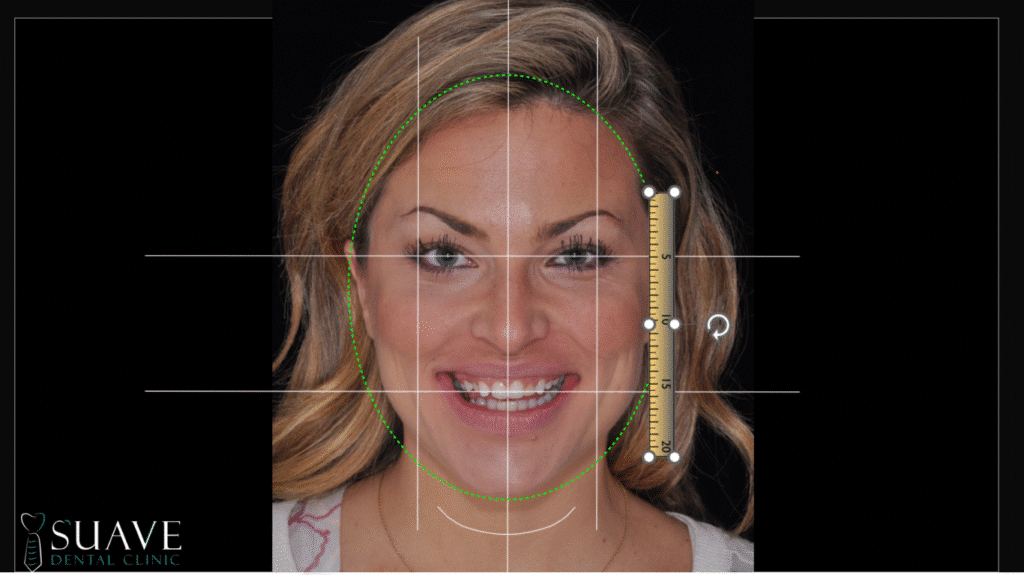 digital smile design uing facial features of the patient