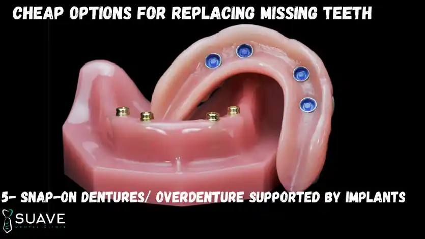 Cheap Options to Replace Missing Teeth 11 implant-supported overdentures /Snap-On-dentures for replacing a full arch