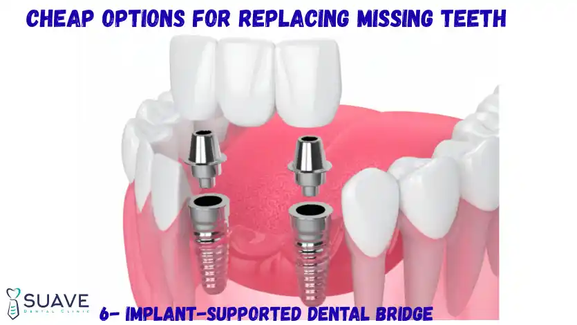 Cheap Options to Replace Missing Teeth 12 implant-supported bridge to replace multiple missing teeth