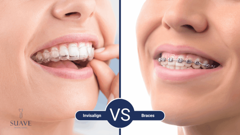 invisalign vs braces, at Suave Clinic