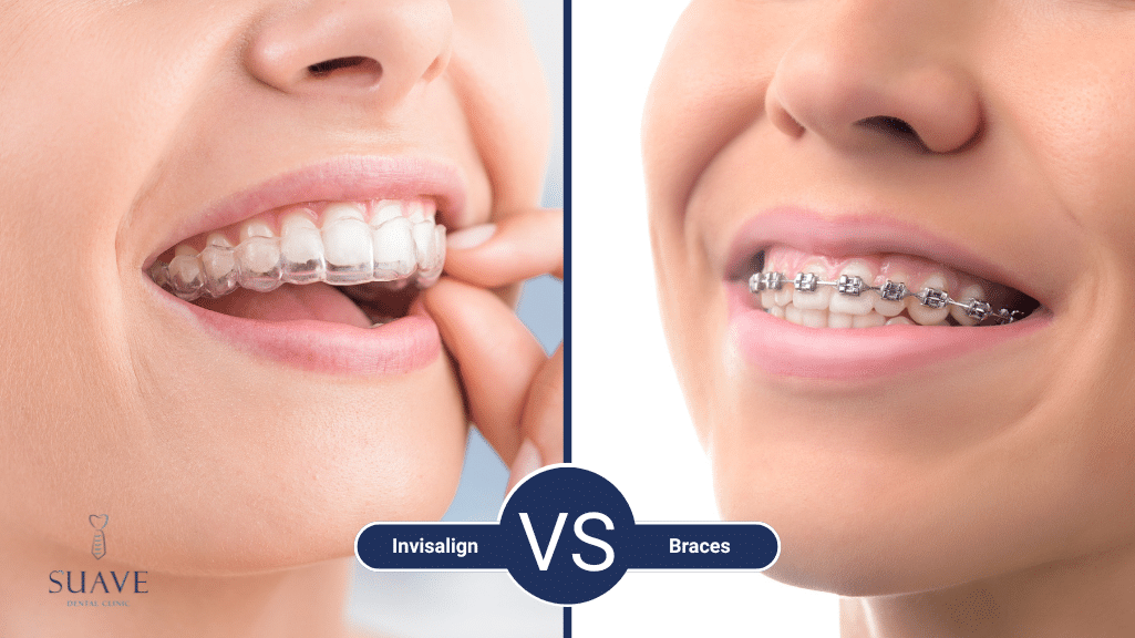 invisalign vs braces, at Suave Clinic