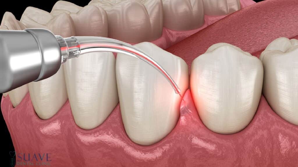 gingivectomy in Turkey at Suave Clinic
