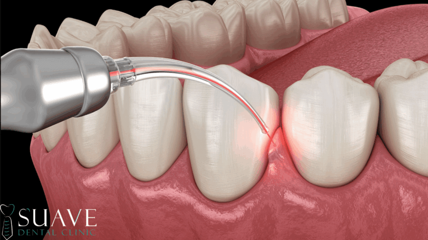 gingivectomy in Turkey at Suave Clinic