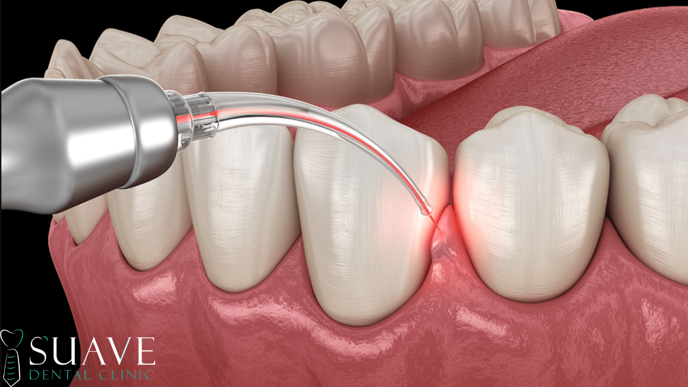 gingivectomy in Turkey at Suave Clinic