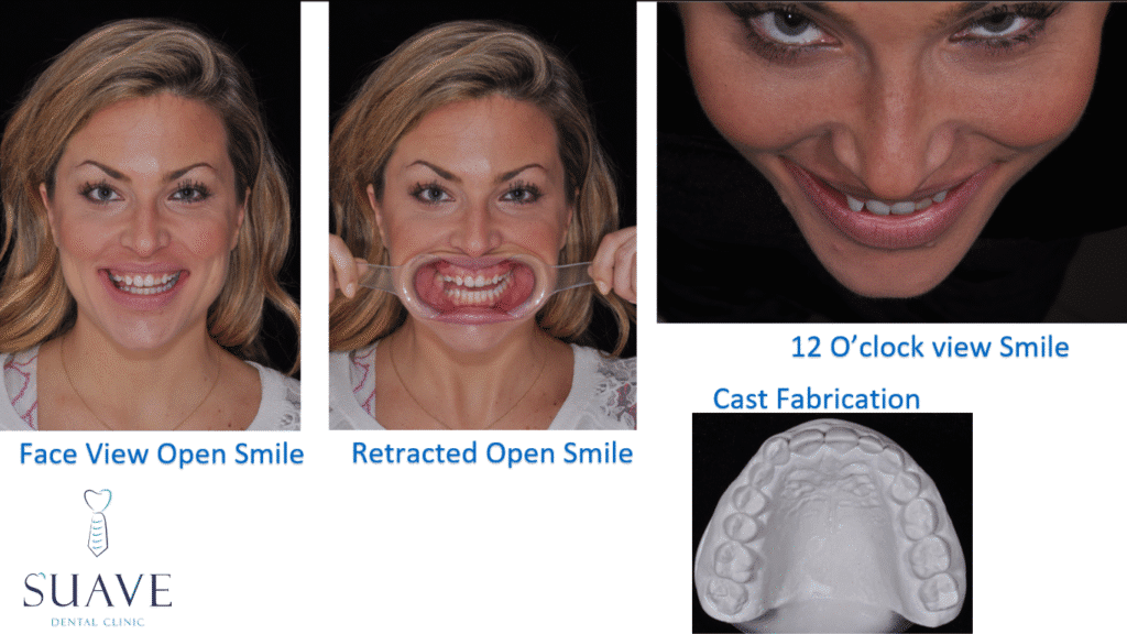 digital smile design photography before and after 