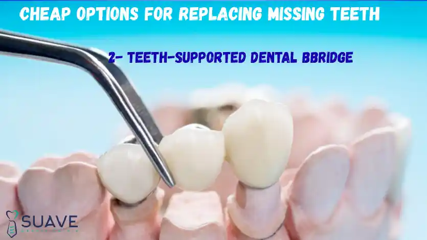 Cheap Options to Replace Missing Teeth 8 teeth supported dental bridge to replace missing teeth