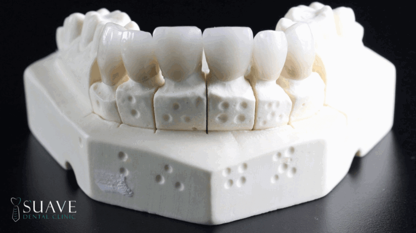CEREC crowns at Suave Clinic
