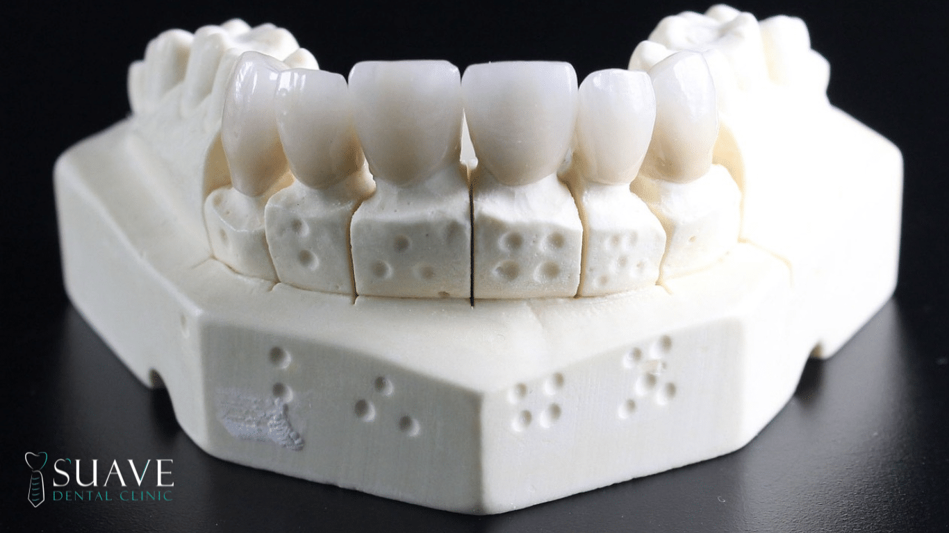 CEREC crowns at Suave Clinic