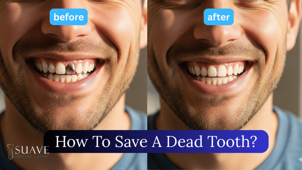 how to save a dead tooth at Suave Clinic